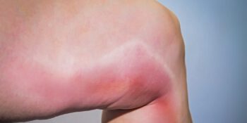 Trombose Venosa Profunda: Sintomas, Causas e Tratamento