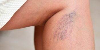 Tratamento avançado de varizes com laser, técnicas modernas e sedação consciente