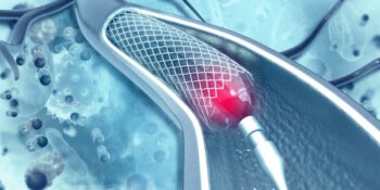 Angioplastia de carótidas com stent