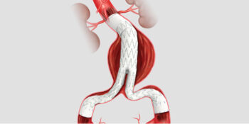 Endoprótese de aorta para aneurisma